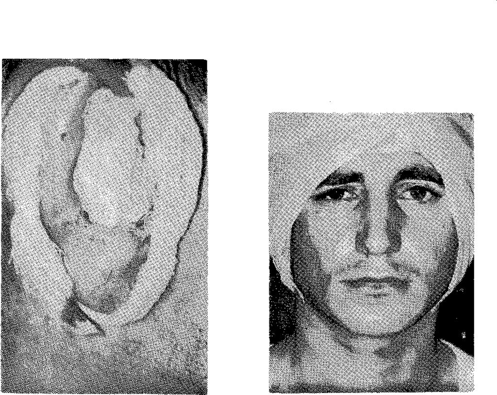 TARTIŞMA VE SONUÇ Bilindiği gibi kepçekulak deformitelerinde temel anatomik bozukluk, kulak sayvanı kıkırdağında lokalize olmuş bir yetersizliktir.