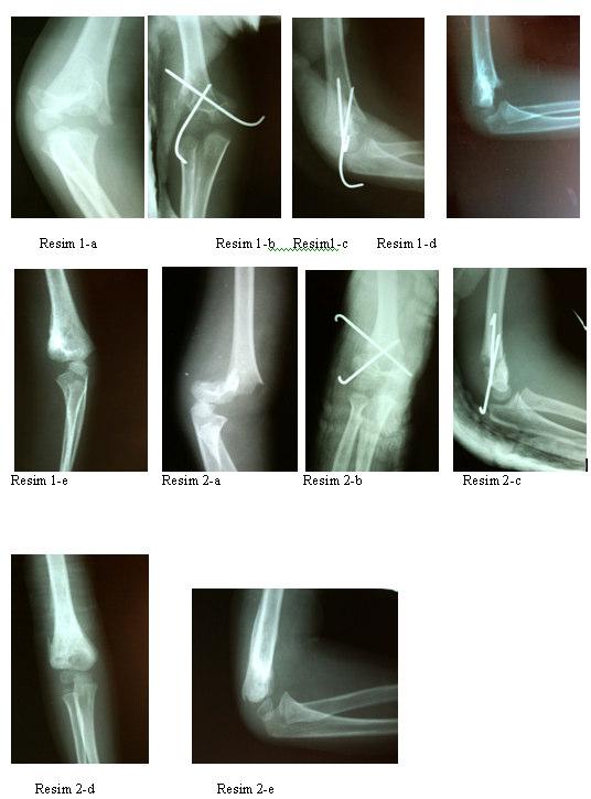 Bulgular: Hastaların fonksiyonel ve kozmetik sonuçları Flaynn kriterlerine göre incelendiğinde (Tablo 2) Grup 1de % 91, Grup 2 de ise % 89 tatminkar sonuç elde edildi.