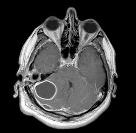 Resim 1. Sağ kulakta otitis media ile sağ serebellar hemisferde yaklaşık 3 cm çapında apse ve sağ serebellar hemisfer posterior kısmında lateral çapı 3.5 cm, ön-arka çapı 1.