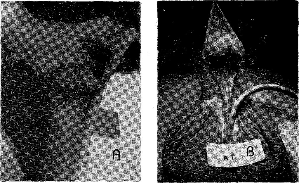 Meatusun sonlandığı bölümden distalde uretra bulunmamakta ve burada atrofik deri, Buck's ve Dartos fasiyaları, corpus spongiosum artıklarından oluşan fibröz bir doku bulunmaktadır (Şekil 1 B).