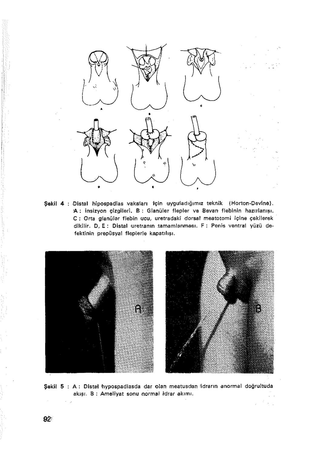Şekil 4 : Distal hipospadias vakaları için uyguladığımız teknik (Horton-D evine}. A : insizyon çizgileri.