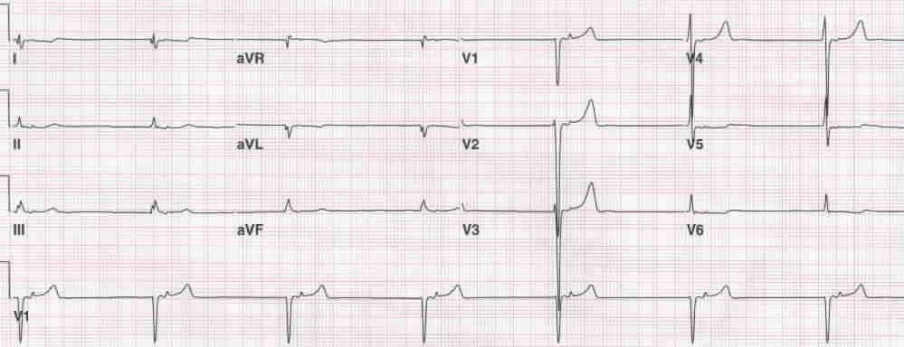 Defibrilasyon 1 şok ver Monofazik - 360 J Manuel bifazik 120-200 J Göğüs basısına devam et 2 dakika Şarj ederken göğüs basısını kesme 1