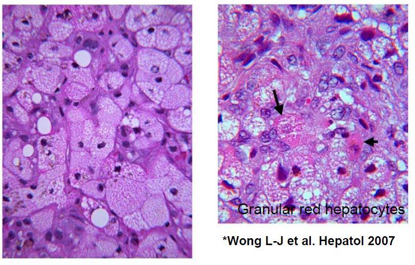 Mitokondriyal Hepatopatiler Histolojik