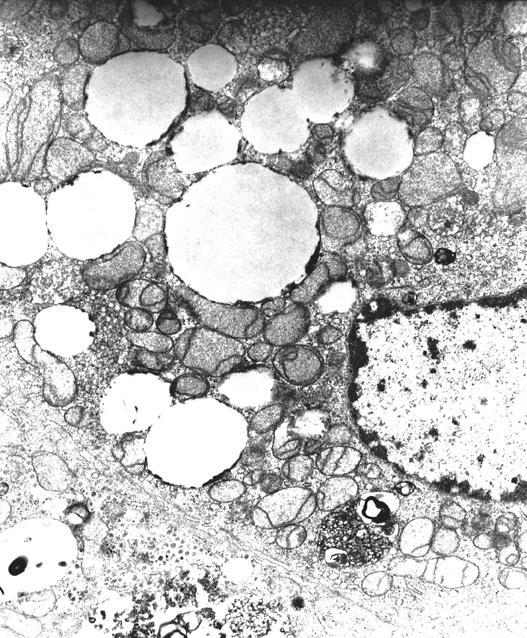 Mitokondriyal Hepatopatiler - Histolojik Bulgular Alpershastalığında hızlı bir fonksiyonel hepatosit kaybı olur Kronik olgularad hepatik fibrozis ve mikronodüler siroz gelişir Bazı olgularda