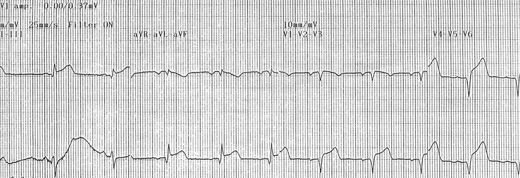 Bölgeleri ve EKG Derivasyonları İle Korelasyonu EKG Miyokard