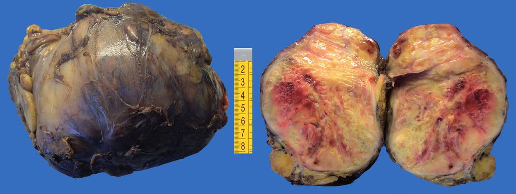 görünümde solid, fokl dejenertif, peritonel yüzeyi düzgün görünümlü tümör izlendi (Şekil 2). Tümör histolojik incelemede iyi difernsiye ve dediffernsiye lnlr içermekteydi.