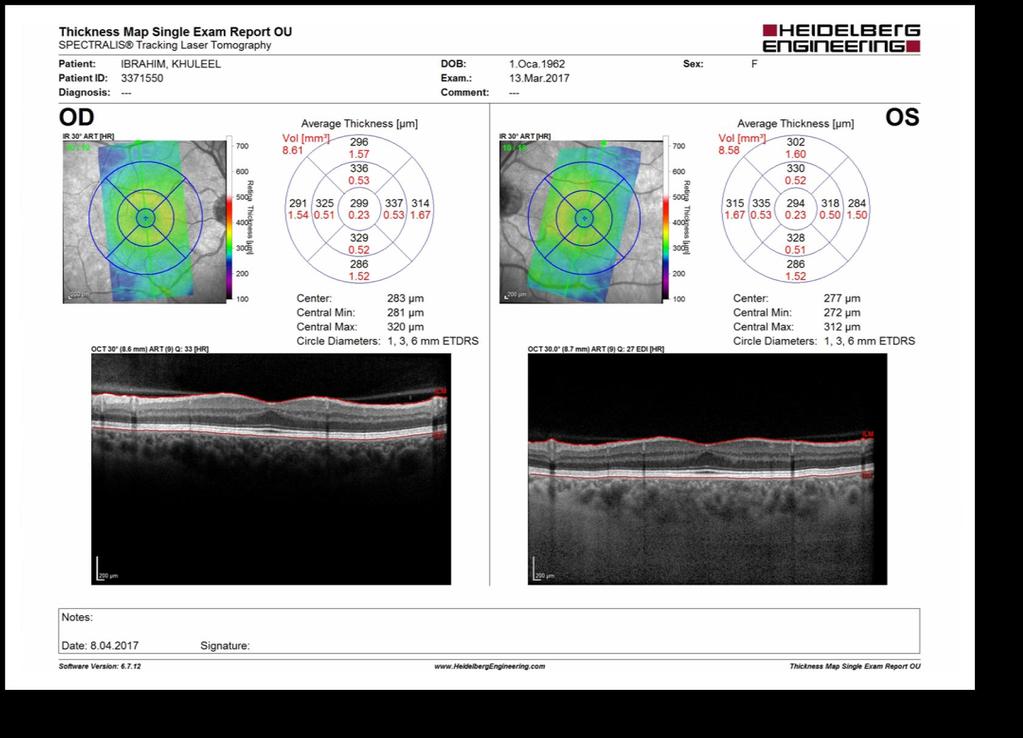 Posterior Kutup Kalınlık Haritası Dikey Tarama 30 X15 dikey tarama 19 B-scan FoDi aksına dik