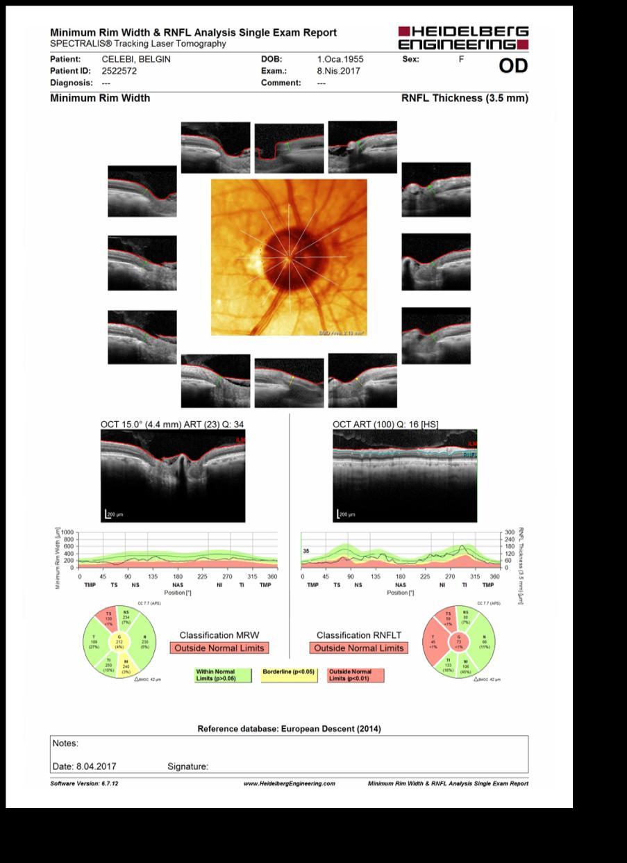 MRW ve RNFL Analizi xxxxxxxxxxxxxx ONH kesit