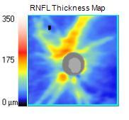 ONH ve RNFL Analizi: Disc