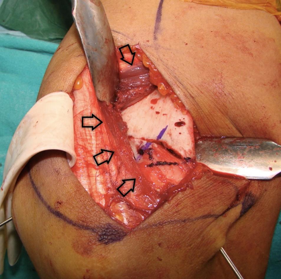 Dirsek çevresi cerrahi yaklaşımlar 5 Şekil 4. Triseps ayırma tekniği. Proksimalde radyal sinirin trasesi düşünülerek, olekranona kadar triseps kesilir. Daha sonra periost ve eklem kapsülü açılır.