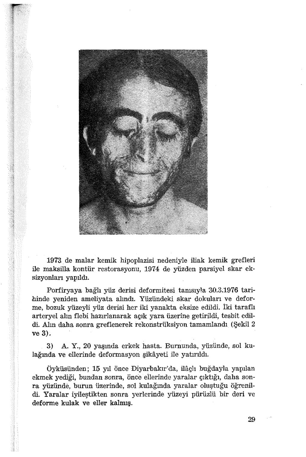 19T3.de malar kemik hipoplazisi nedeniyle iliak kemik grefleri ile maksilla kontür restorasyonu, 1974 de yüzden parsiyel skar eksizyonları yapıldı.