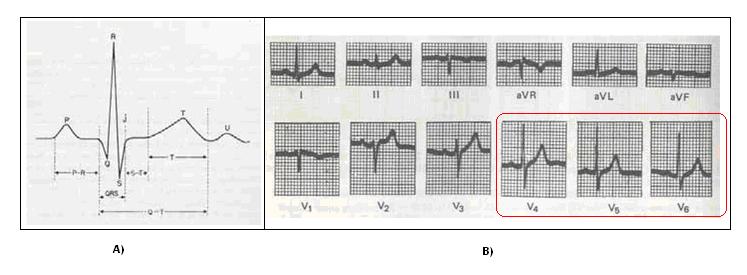görüldüğü üzere analog devre ile EKG sinyalleri uygun bir şekilde yükseltilebilmiştir.