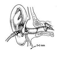 30 Dış kulak yoluna giren kulaklıkların ses üreteci harici bir kutu içerisinde bulunur ve ses sinyalleri ince bir boru ile kulak yoluna iletilir.