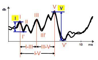 56 Otomatik değerlendirme aşamasında tüm dalgaların şablon ile örtüştürülmesinin yanı sıra Şekil 3.16 da görülen I., III. ve V.