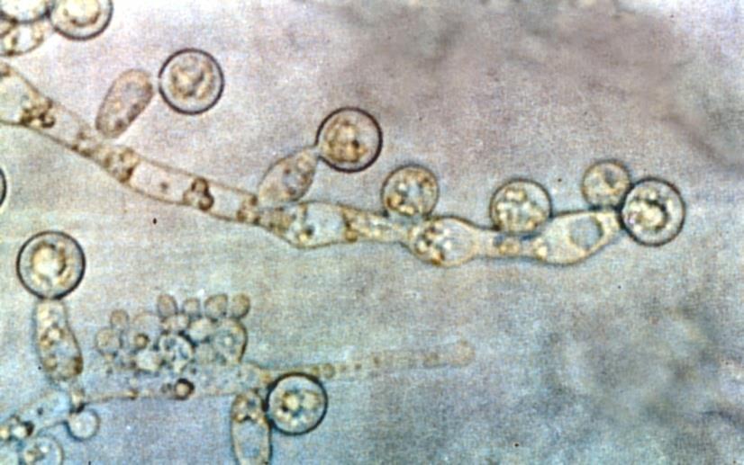 Kandida infeksiyonları Candida non-albicans ta artış C. parapsilosis C. glabrata (flukonazole duyarlılığı düşük) C.