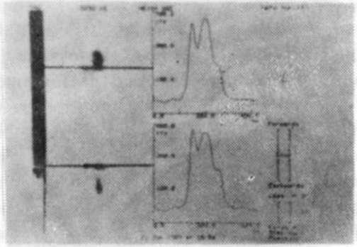 TME Bozukluklarında Radyografi ve Sintigrafinin Tanı Değerleri G.Ü. Dişhek. Fak. Derg., 1995 Önce planar imajlar Epstein'in (7) 0-1-2 skalası kullanılarak görsel olarak değerlendirildi.