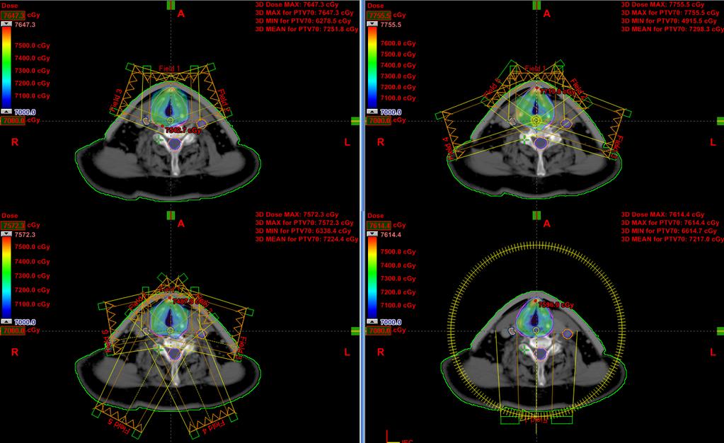 Doz(70Gy/35fr) PTV %95 e normalize edildi.