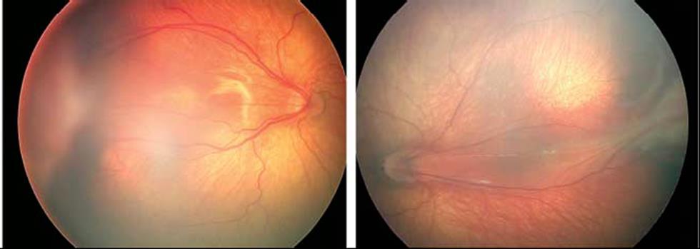 EVRE 5 Total retina dekolmanı