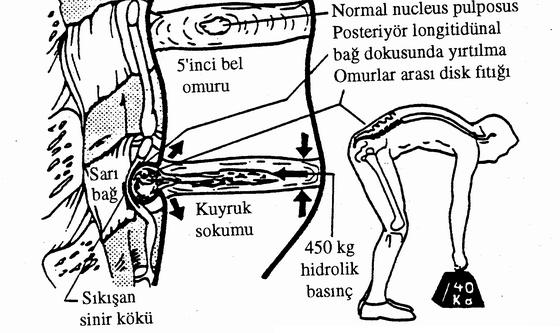 Gövdesini öne bükerek 40 kilogram bir ağırlığı yerden kaldıran normal bir insanın, bel omurları arasındaki fibroelastik kıkırdak dokusu üzerine 450 kg yük binebilmektedir.