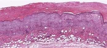 Sklerozan Enkapsüle Peritonit (SEP) Histopatolojik değişiklikler; - peritondaki mezotelyal hücrelerin ve fibroblastların aşırı üretimi - epitelyal mezenkimal dönüşüm (mezotel hücrelerinin epitel