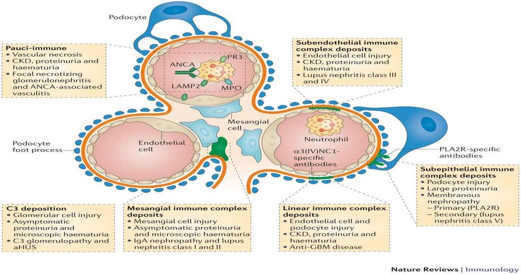 İmmunkompleks Birikimi Glomerülonefritler Pausi-immun Vasküler nekroz KBH, proteinüri, hematüri Fokal nekrotizan glomerulonefrit ve Subendotelyal immun kompleks birikimi Endotel hc hasarı KBH,