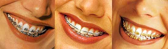 Sadece dişlerin hareketi ortodontik etki dir Ortodontik etki intraoral mekanik