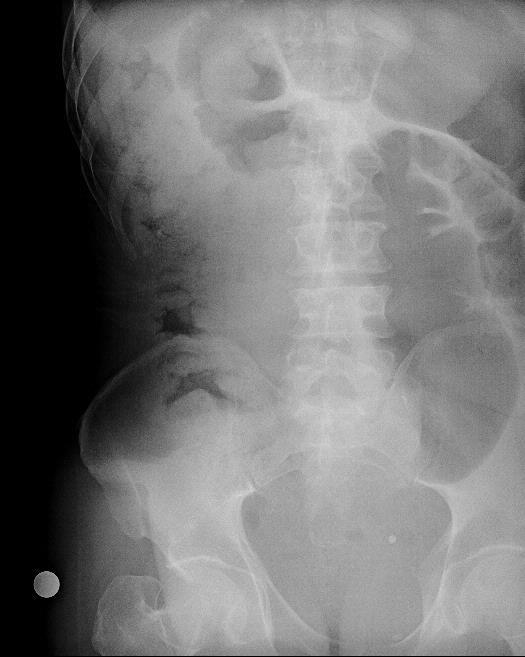 There was large dilation of the proximal small intestine and colonic segments because of the fecaloma obstruction.