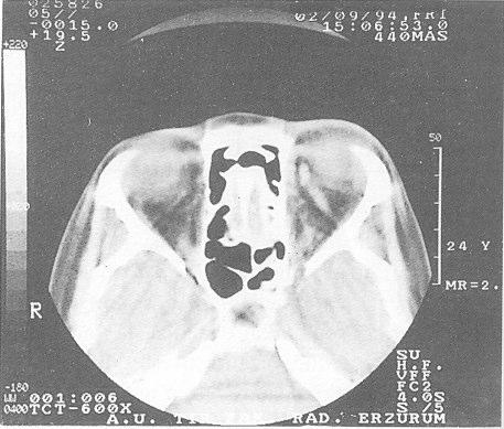 US ile sað gözde travmatik katarakt, bilateral retina dekolmaný ve subretinal hemoraji izleniyor. Þekil 3b. Ayný görünümün tomografik kesiti. Superior oftalmik vende dilatasyon görülüyor.