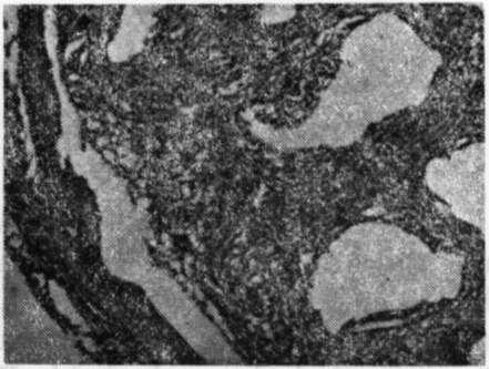 KAVARYA DEFEKTLERİNDE BlOCORAL'İN ETKİSİ dan boşluğa doğru uzandığı dikkati çekti (Resim 3). Bir örnekte partiküllerin kemiğin iç yüzeyi boyunca dağıldıkları ve dev hücrelerce çevrelendikleri görüldü.