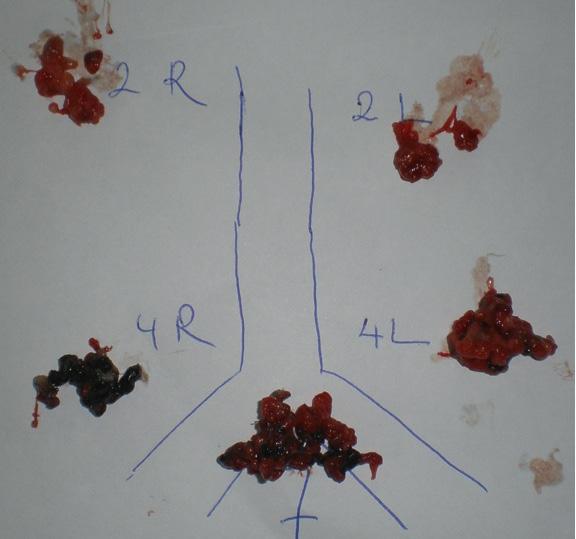 EBUS-TBİA da ise, maliyetli bir sarf malzemesi Şekil 1. Endobronşial ultrasonografi Şekil 2.