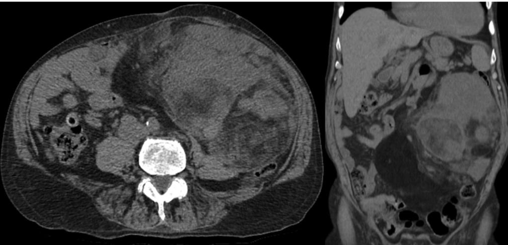 GİRİŞ Retroperitoneal sarkomlar tüm yumuşak doku sarkomlarının % 15 ini oluşturan nadir tümörlerdir. En sık histolojik tipi liposarkomdur (1). Sıklıkla 40-60 yaş arası görülmektedir (2).