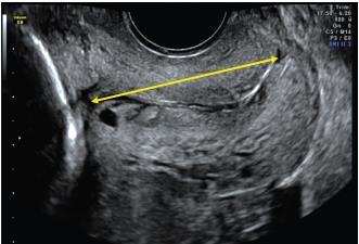 Transvaginal ultrasound Prob tarafından servikse