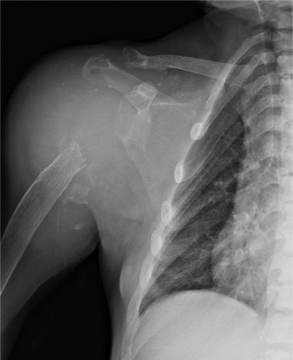 Anteroposterior right shoulder radiography of a male patient on longterm renal replacement treatment. Notes: DRA totally destroyed right humerus head.