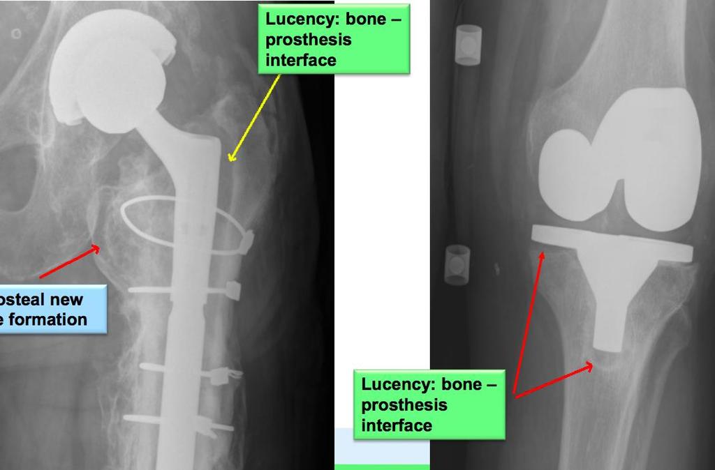 Görüntüleme: Kronik Protez İnfeksiyonu Protez ve kemik arasında lüsens artışı Periostal yeni kemik oluşumu >2mm lüsens artışı