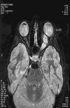 1 and bilateral optic