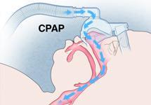 2.4.6.3.1. Continuous Positive Airway Pressure (CPAP) CPAP tedavisi OUAS için etkin, güvenilir ve standardize bir tedavi şeklidir (114, 115).