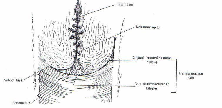 ortamı ile karģılaģtığında, kolumnar epitelin harabiyetine ve metaplastik squamoz epitelyum oluģumuna neden olur ve bu metaplazi, orijinal SCJ nin iç kısmından eksternal os a doğru ve kolumnar