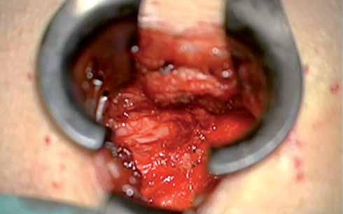 Lomber disk herniasyonu cerrahisi sonrası gelişen epidural fibrozisin engellenmesi amacıyla ligamentum flavumun korunduğu mikrodiskektomi girişimi de yapılmaktadır (14).