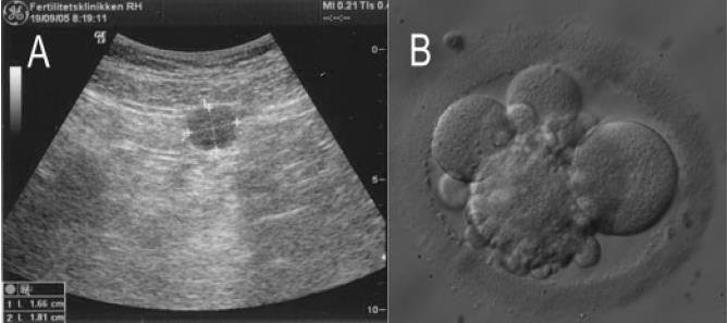 Transplantasyon sonrası ART Heterotopik bölge 4-hücreli