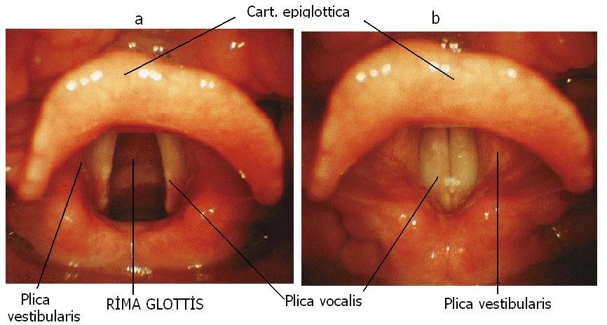 Üst bölüm (Vestibulum Laryngis) Larynx boģluğunun, gırtlak giriģinden yalancı ses tellerine (plica vestibularis) kadar olan üst tarafı geniģ, alt tarafı dar olan ilk bölümüdür (Resim 1.8). Resim 1.