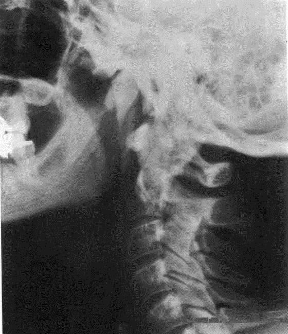 Tracheanın Lateral Pozisyonda Görüntüsü Resim