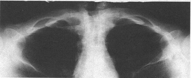 Apiklordotik Akciğer Radyografisinde Anatomik Yapı