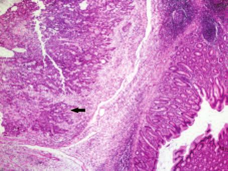 tiroidit (HE, x200). teren atipik epitel hücreleri ile döşeli papiller yapılar gözlenmiştir (Resim 5).