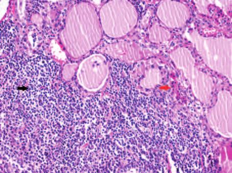 Papiller mikrokarsinom gelişen olguda tümör belirteçlerinden CA-19,9 yüksek (302 U/mL), skuamöz hücreli karsinom gelişen olguda