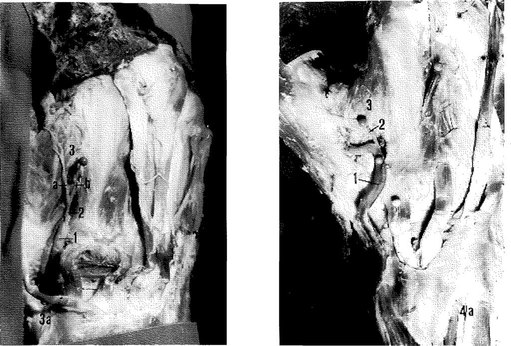 Bu nedenle önem li b ir o lu şu m o lan AM CD T in c e rra h i yaklaşım larda gereği kadar korunabilm esi için arterio g rafik d eğ erlen d irilm esi ile b irlik te tip lerin in de göz ö n ü n d e b