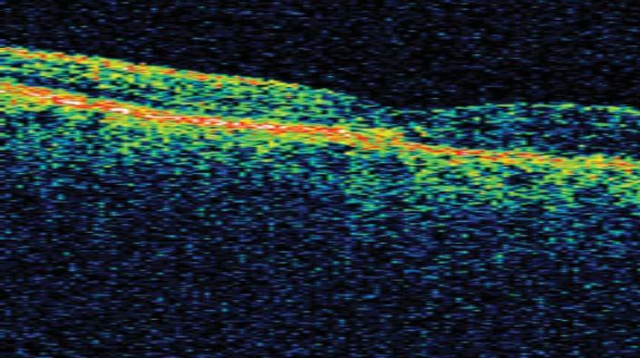 SRS si bulunan gözlerin ortalama preoperatif RD süresi 76.6±2.7 (7-240) gün iken, SRS si bulunmayan gözlerin preoperatif ortalama retinal dekolman süresi 16±4.5 (7-45) gün idi.