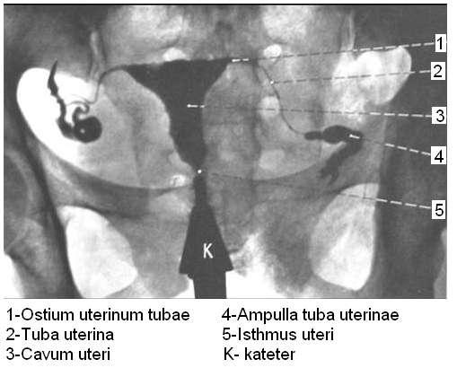 Resim 2.9: Histerosalpingogram (H.S.G.) 2.1.4. Vagina (Colpos, Hazne) Vagina; yukarıda uterus boynu, aģağıda vulva arasında oblik olarak uzanan fibromuskuler boru Ģeklinde bir organdır. (Resim 2.