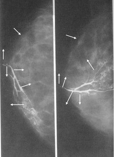 Mamografi ile elde edilen radyogramda anatomik yapıyı gösteriniz.