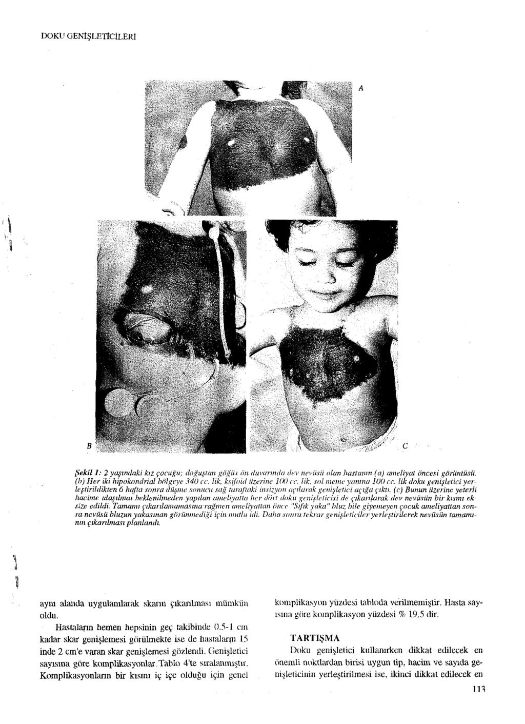 DOKU GENİŞLETİCİLERİ Şekil 1 :2 yaşındaki kız çocuğu; doğuştan göğüs ön duvarında dev neviisü olan hastanın (a) ameliyat öncesi görüntüsü, (h) Her iki hipokondrial bölgeye 340 cc.
