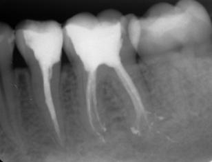Keleş ve Ocak; Üç mezial kanallı mandibular birinci molar Bir hafta sonraki randevuda hastanın şikayetleri tümüyle geçmişti.